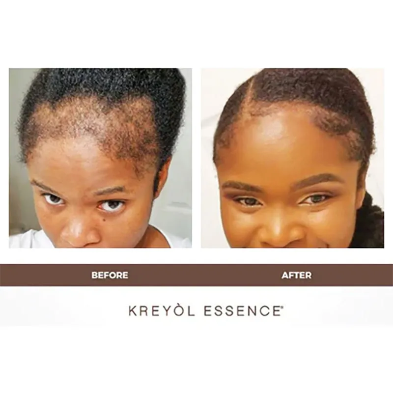 Buy 1 HBCO Rosemary Peppermint 3.4oz & Get 1 FREE Pomad Kreyol 4oz | "Save My Hairline" Growth Treatment Duo